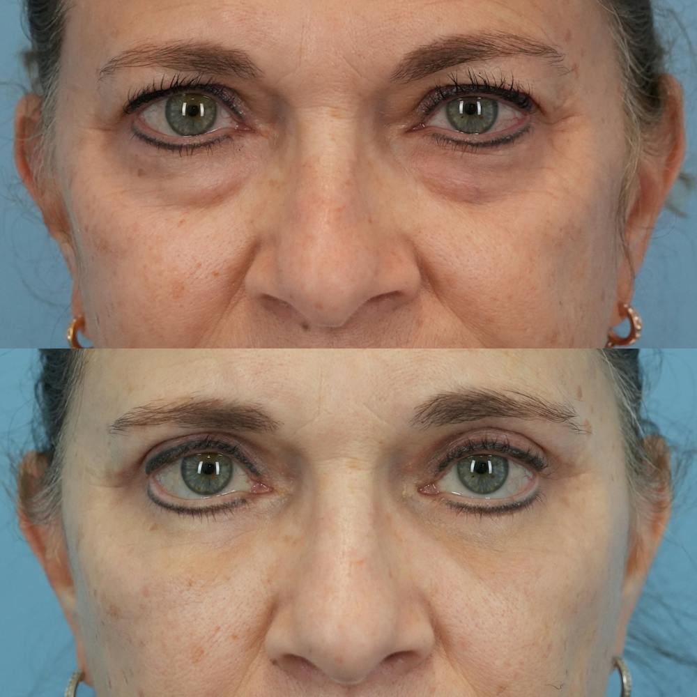 Blepharoplasty Before & After Gallery - Patient 576224 - Image 1