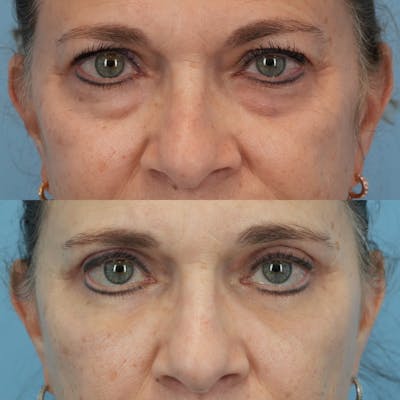 Blepharoplasty Before & After Gallery - Patient 576224 - Image 1