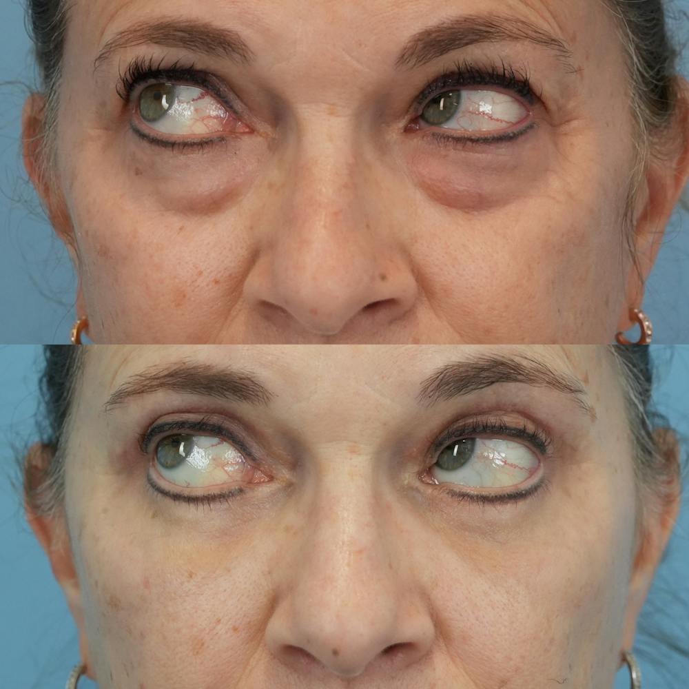 Blepharoplasty Before & After Gallery - Patient 576224 - Image 5