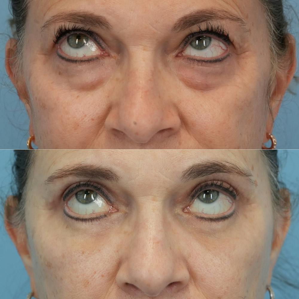 Blepharoplasty Before & After Gallery - Patient 576224 - Image 2
