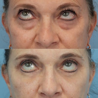Blepharoplasty Before & After Gallery - Patient 576224 - Image 2