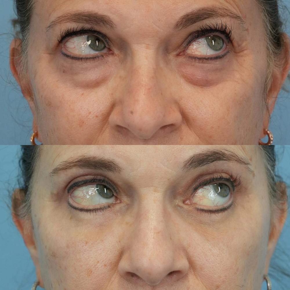 Blepharoplasty Before & After Gallery - Patient 576224 - Image 4