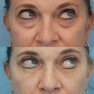 Blepharoplasty Before & After Gallery - Patient 576224 - Image 4