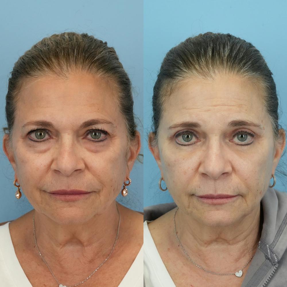 Blepharoplasty Before & After Gallery - Patient 576224 - Image 6