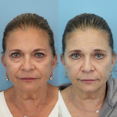 Blepharoplasty Before & After Gallery - Patient 576224 - Image 6