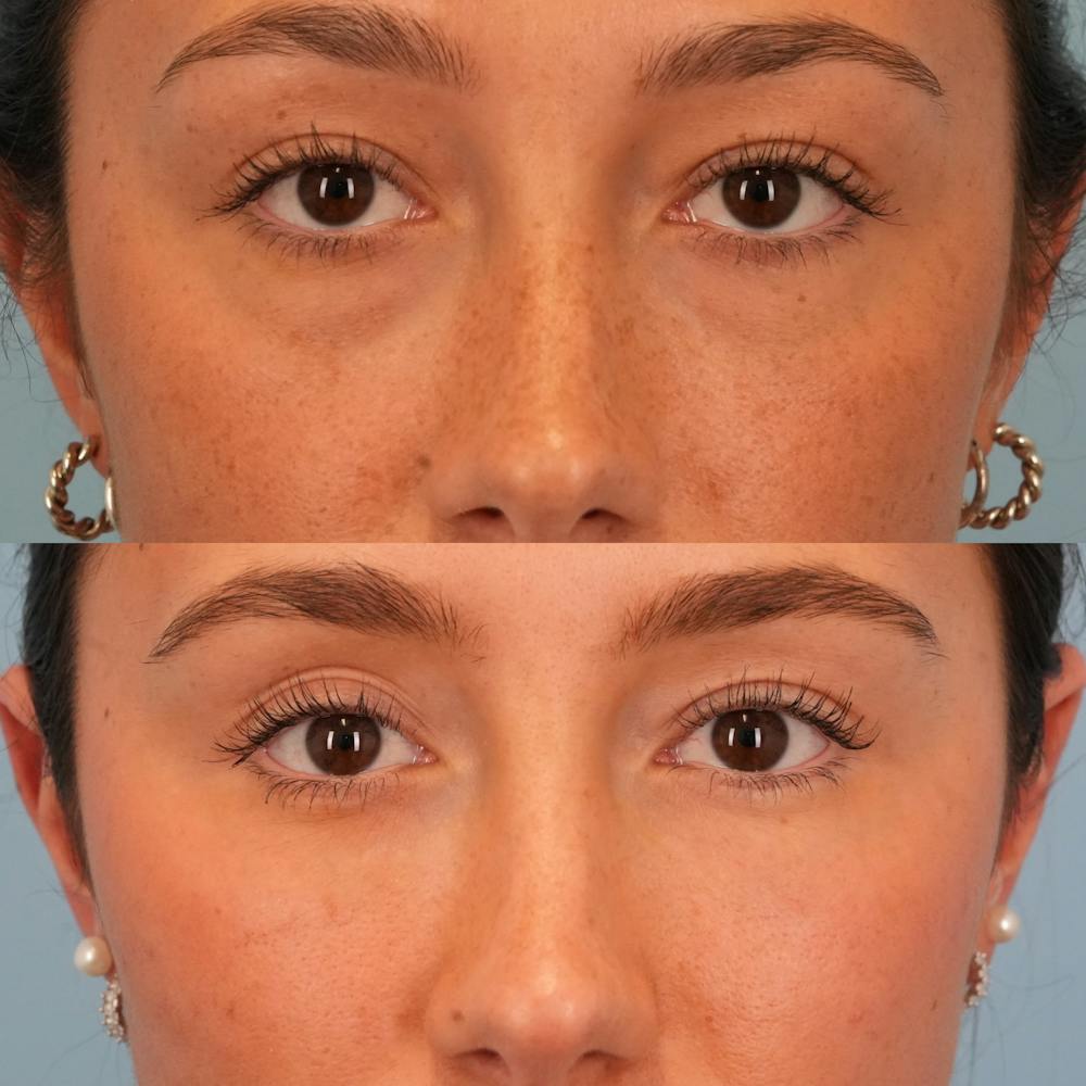 Blepharoplasty Before & After Gallery - Patient 144573 - Image 1