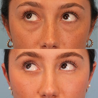 Blepharoplasty Before & After Gallery - Patient 144573 - Image 4