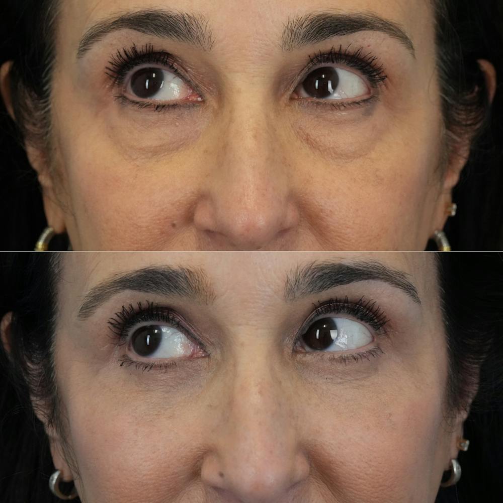 Blepharoplasty Before & After Gallery - Patient 281040 - Image 5