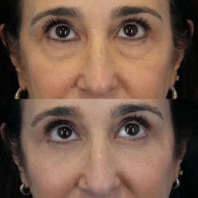 Blepharoplasty Before & After Gallery - Patient 281040 - Image 2