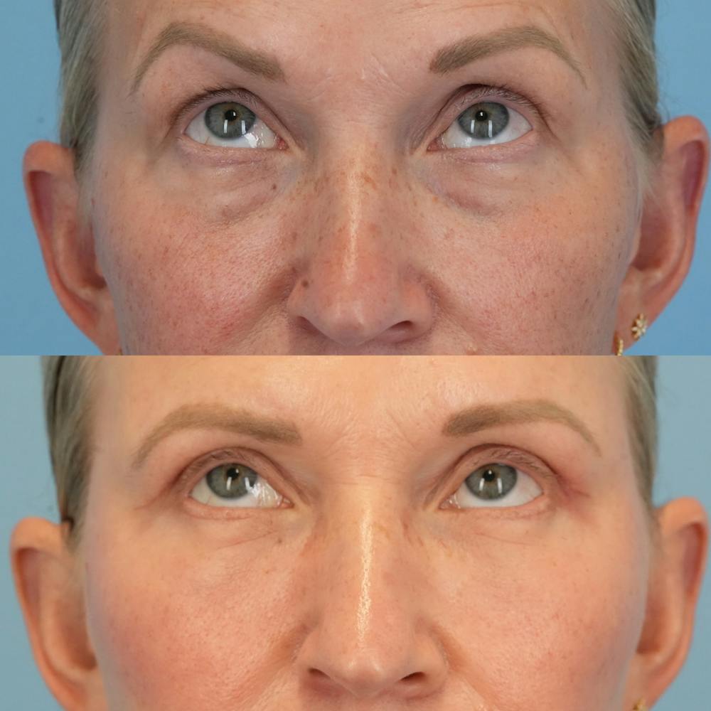 Blepharoplasty Before & After Gallery - Patient 349860 - Image 2