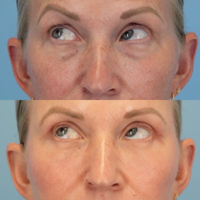 Blepharoplasty Before & After Gallery - Patient 349860 - Image 4