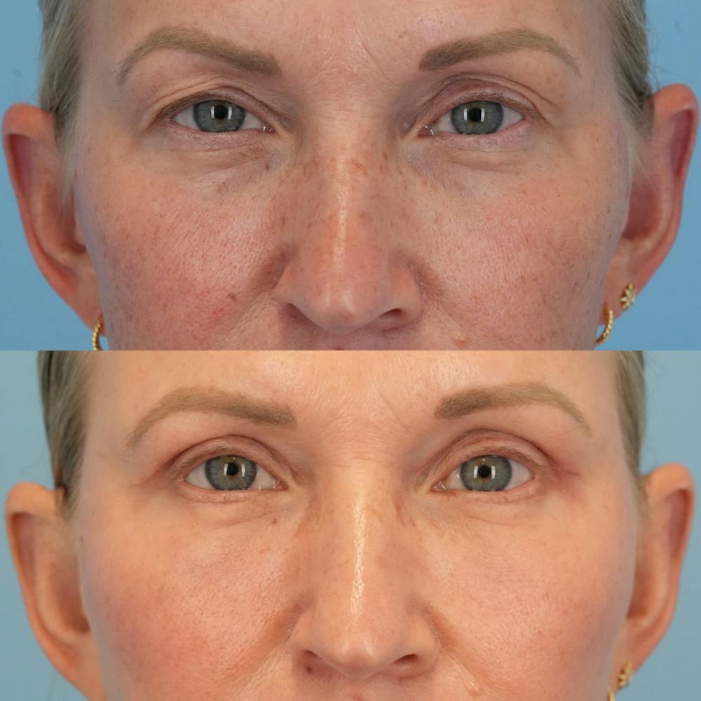 Blepharoplasty Before & After Gallery - Patient 349860 - Image 1