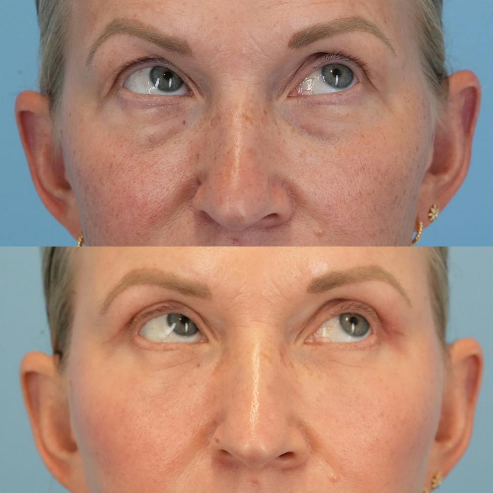 Blepharoplasty Before & After Gallery - Patient 349860 - Image 3