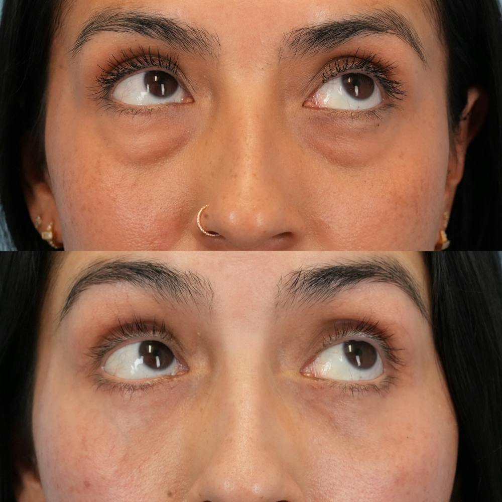 Blepharoplasty Before & After Gallery - Patient 289985 - Image 3