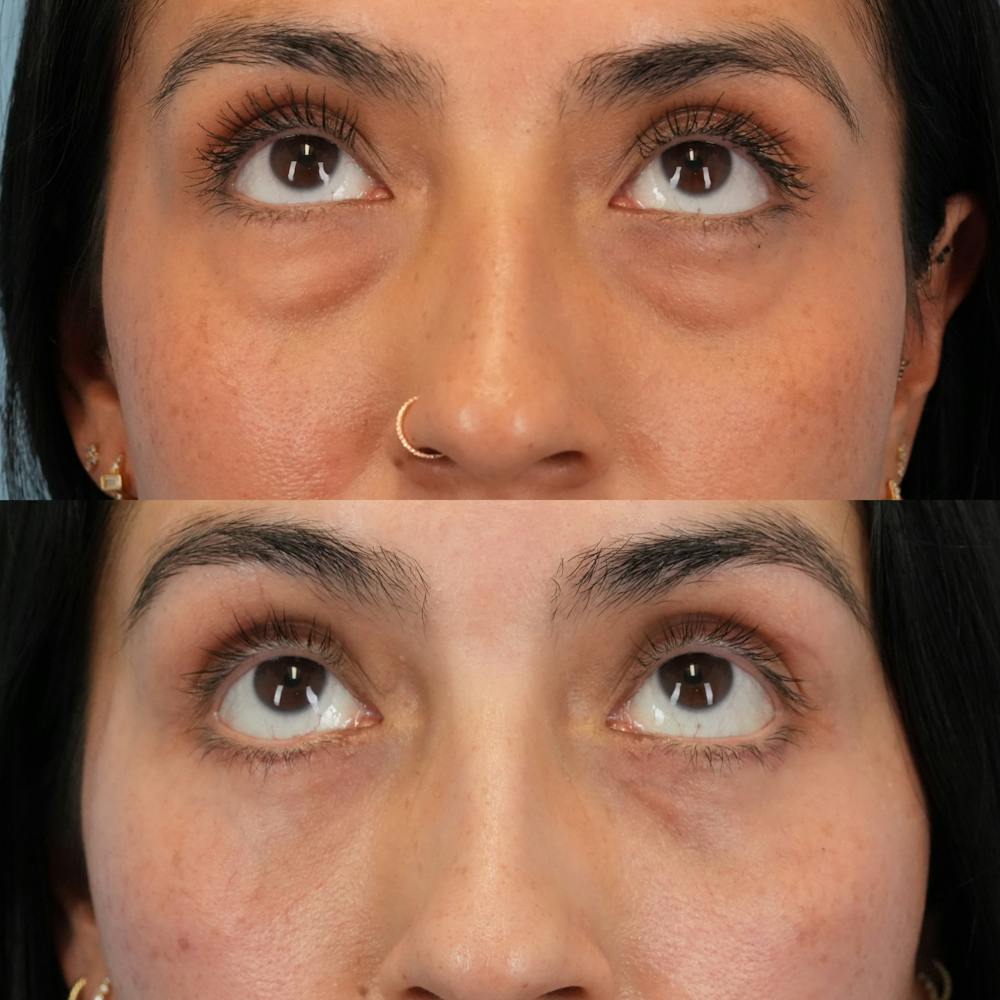 Blepharoplasty Before & After Gallery - Patient 289985 - Image 2
