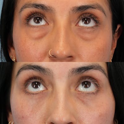 Blepharoplasty Before & After Gallery - Patient 289985 - Image 2