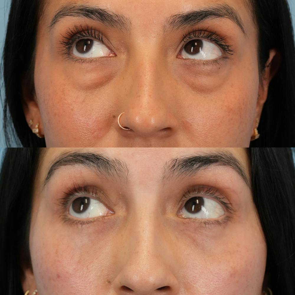 Blepharoplasty Before & After Gallery - Patient 289985 - Image 4
