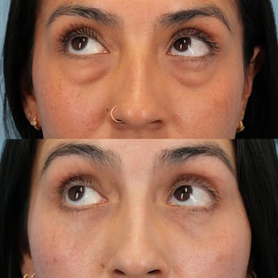 Blepharoplasty Before & After Gallery - Patient 289985 - Image 4