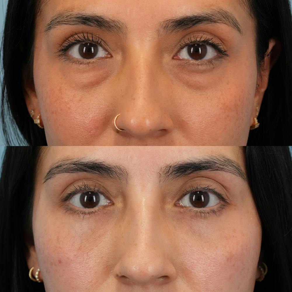 Blepharoplasty Before & After Gallery - Patient 289985 - Image 1
