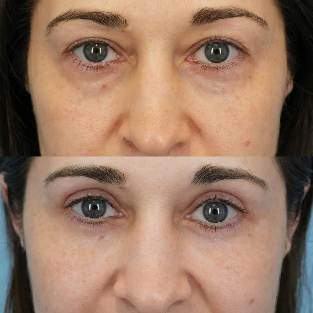 Blepharoplasty Before & After Gallery - Patient 765073 - Image 1