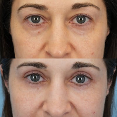 Blepharoplasty Before & After Gallery - Patient 765073 - Image 1