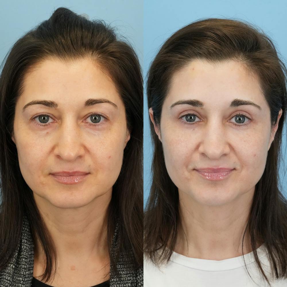 Blepharoplasty Before & After Gallery - Patient 765073 - Image 6