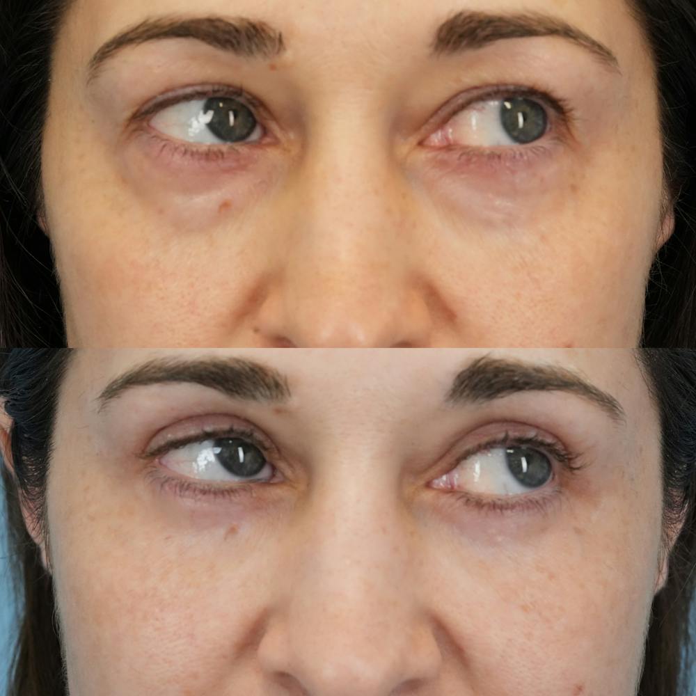 Blepharoplasty Before & After Gallery - Patient 765073 - Image 4