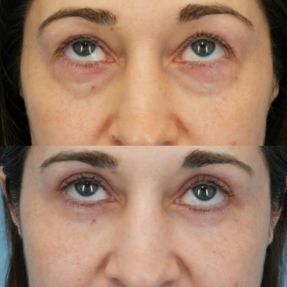 Blepharoplasty Before & After Gallery - Patient 765073 - Image 2