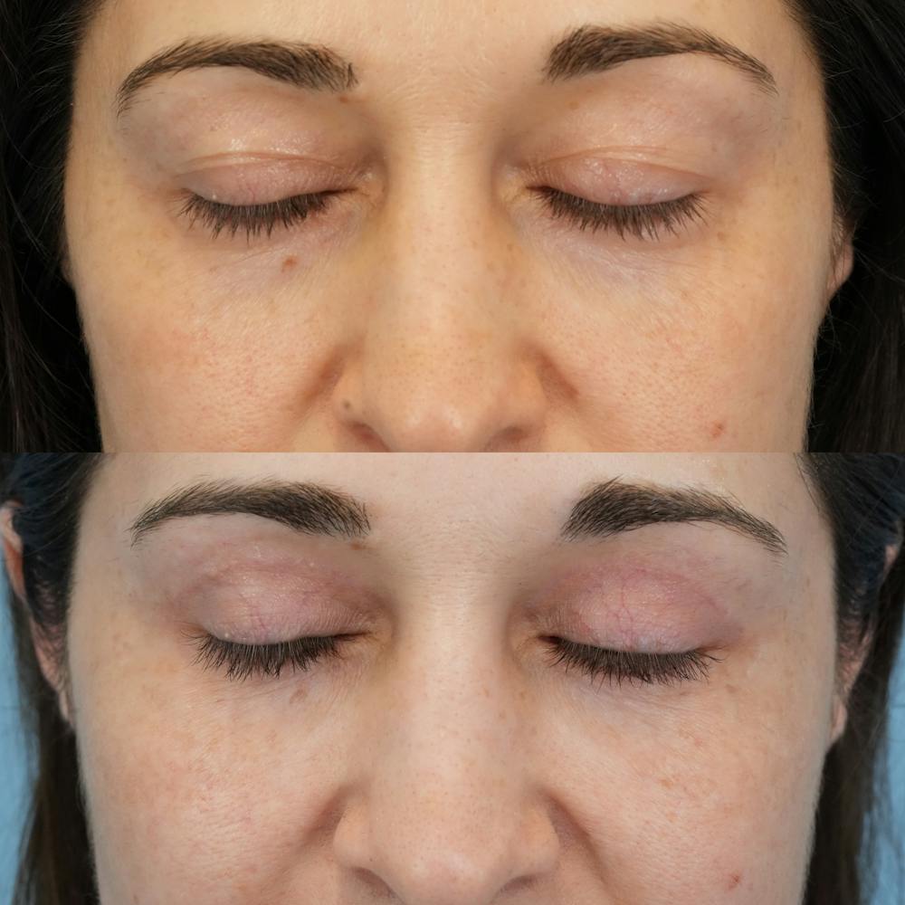Blepharoplasty Before & After Gallery - Patient 765073 - Image 3