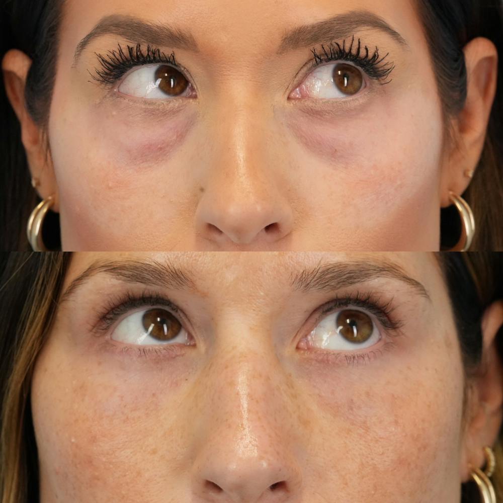 Blepharoplasty Before & After Gallery - Patient 377076 - Image 4