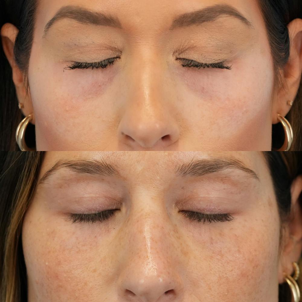 Blepharoplasty Before & After Gallery - Patient 377076 - Image 3