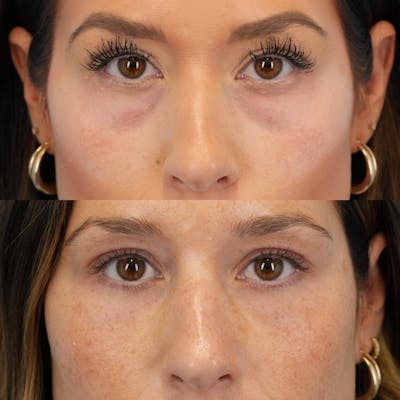Blepharoplasty Before & After Gallery - Patient 377076 - Image 1