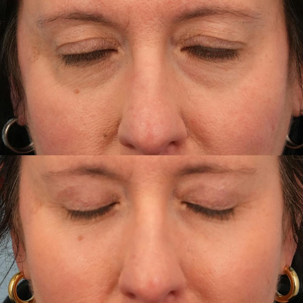 Blepharoplasty Before & After Gallery - Patient 417734 - Image 3
