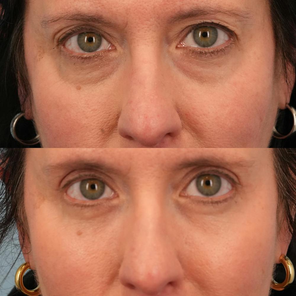 Blepharoplasty Before & After Gallery - Patient 417734 - Image 1