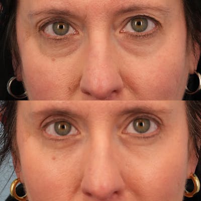 Blepharoplasty Before & After Gallery - Patient 417734 - Image 1