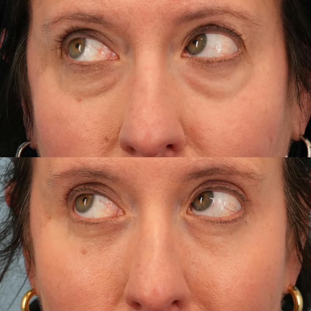 Blepharoplasty Before & After Gallery - Patient 417734 - Image 5