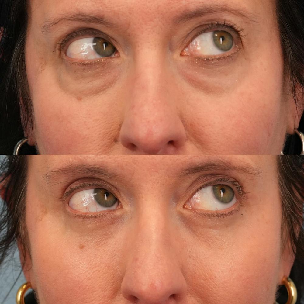 Blepharoplasty Before & After Gallery - Patient 417734 - Image 4