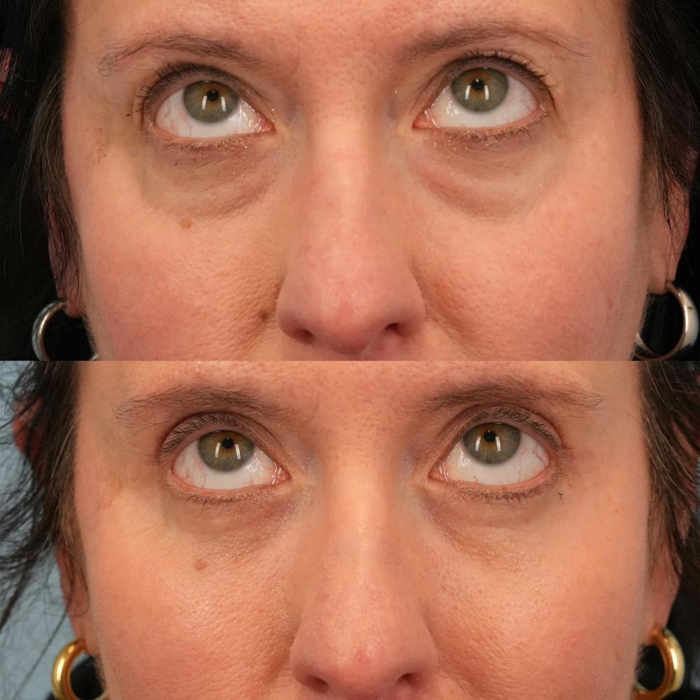 Blepharoplasty Before & After Gallery - Patient 417734 - Image 2