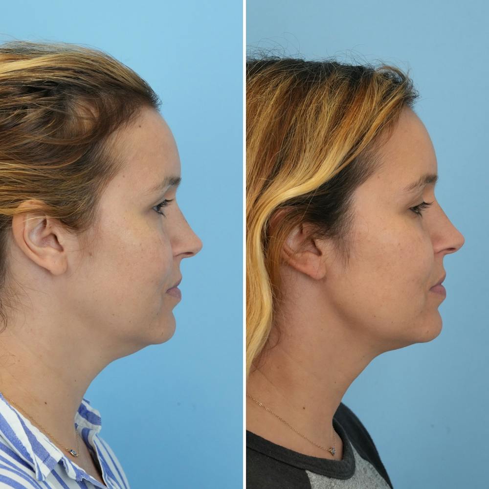 Submental Liposuction Before & After Gallery - Patient 326068 - Image 5