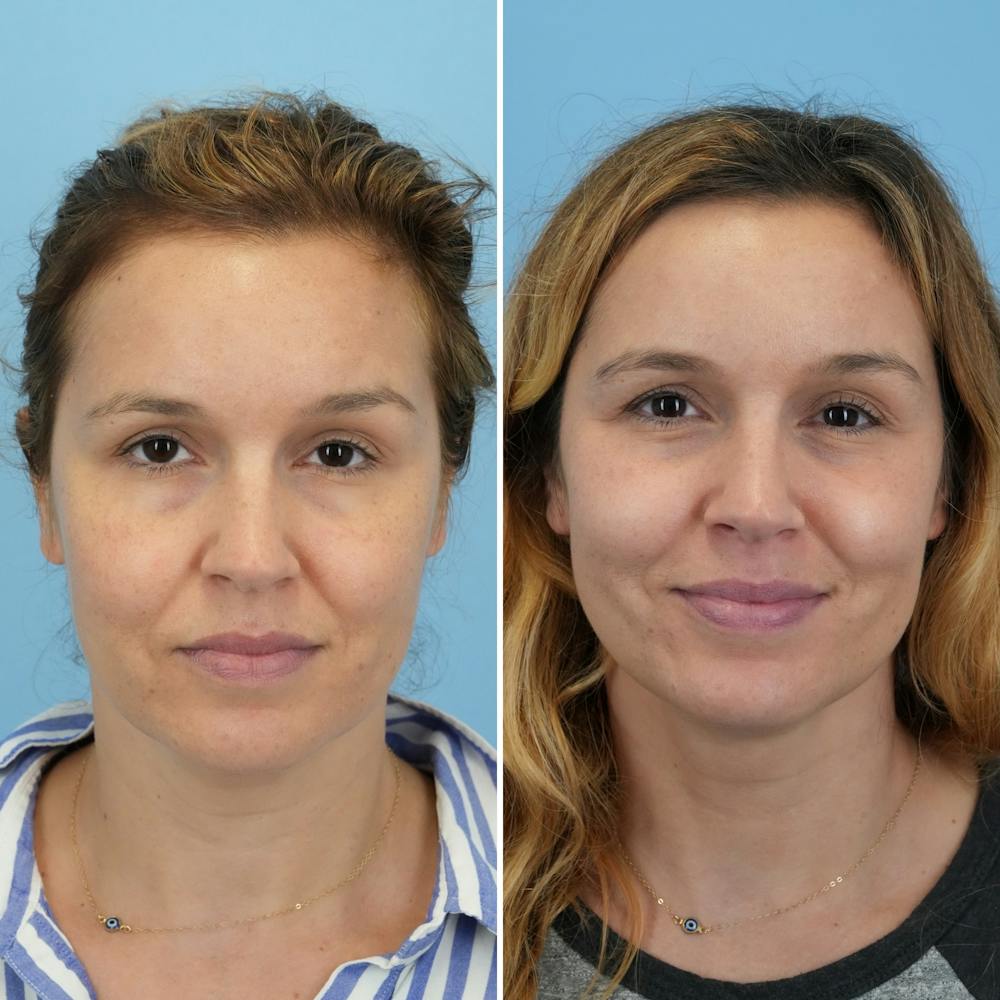 Submental Liposuction Before & After Gallery - Patient 326068 - Image 3