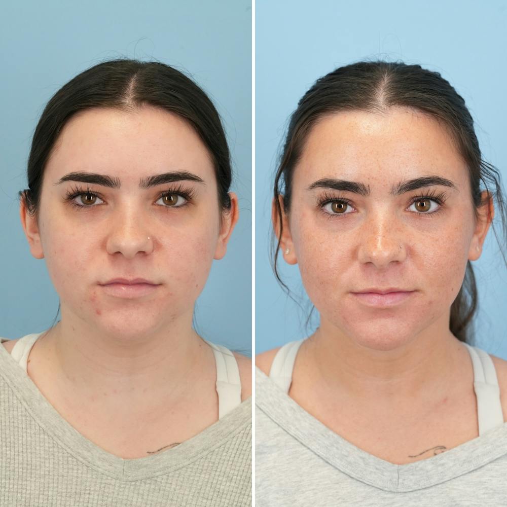 Submental Liposuction Before & After Gallery - Patient 197276 - Image 3