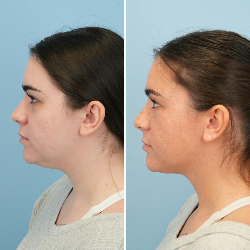 Submental Liposuction Before & After Gallery - Patient 197276 - Image 1