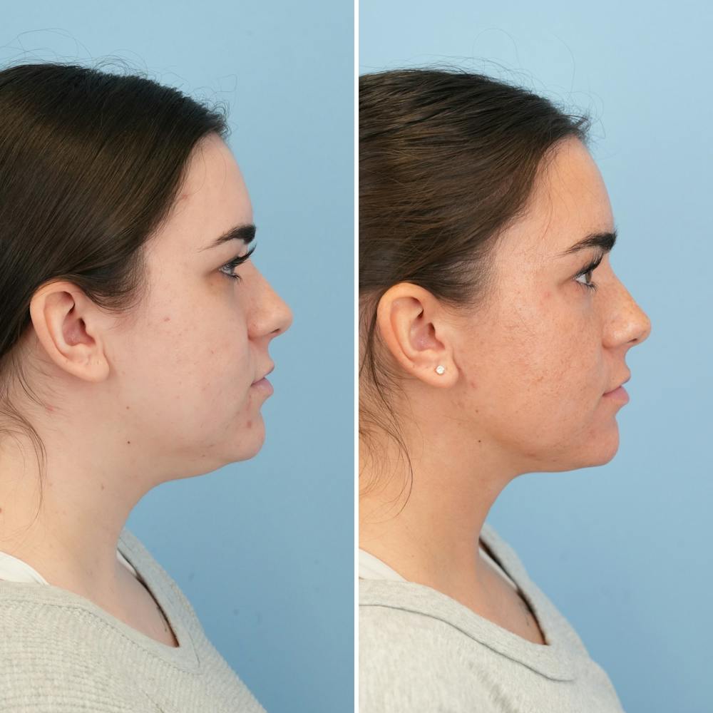 Submental Liposuction Before & After Gallery - Patient 197276 - Image 5