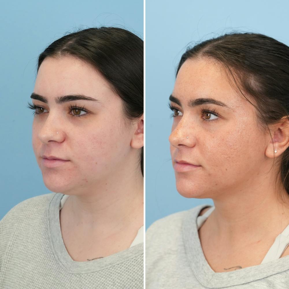 Submental Liposuction Before & After Gallery - Patient 197276 - Image 2