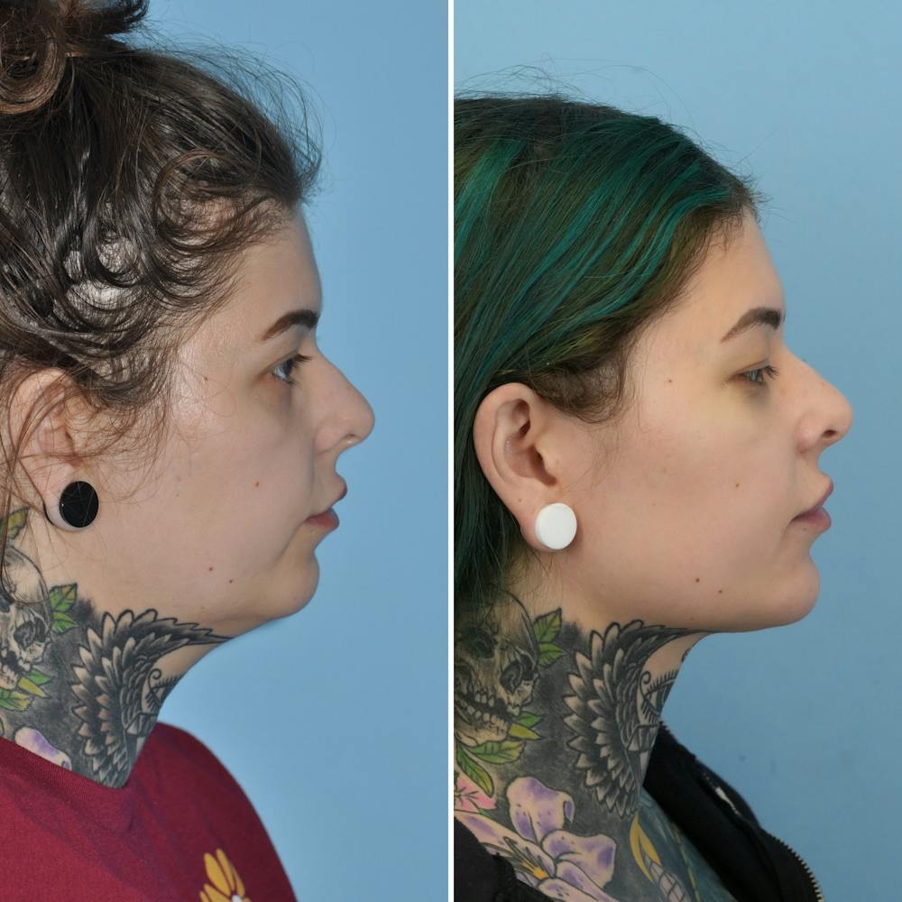 Submental Liposuction Before & After Gallery - Patient 282129 - Image 5