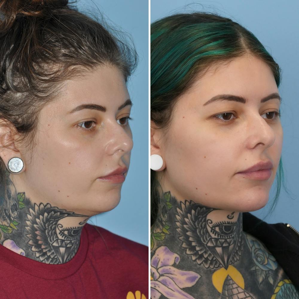 Submental Liposuction Before & After Gallery - Patient 282129 - Image 4