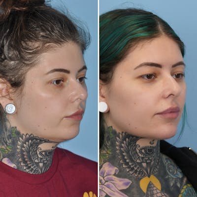 Submental Liposuction Before & After Gallery - Patient 282129 - Image 4