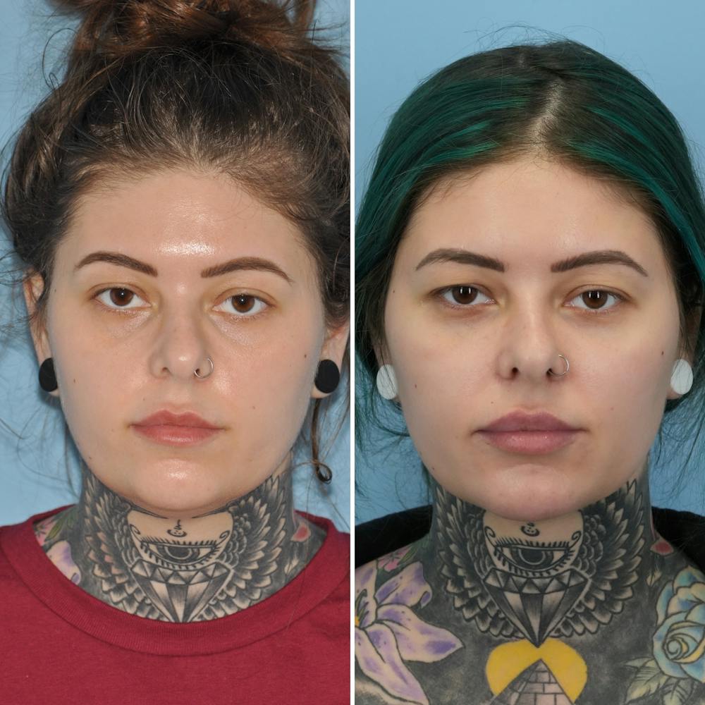 Submental Liposuction Before & After Gallery - Patient 282129 - Image 3