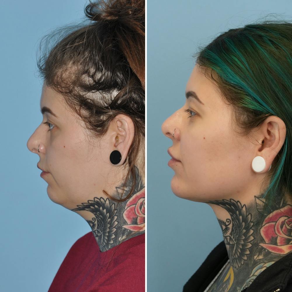 Submental Liposuction Before & After Gallery - Patient 282129 - Image 1