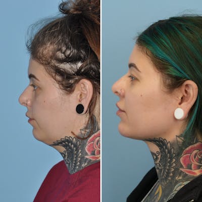 Submental Liposuction Before & After Gallery - Patient 282129 - Image 1